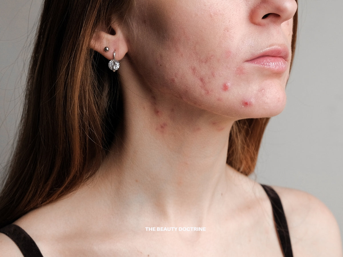 How to Fix Acne Naturally: Root Cause Approach | The Beauty Doctrine