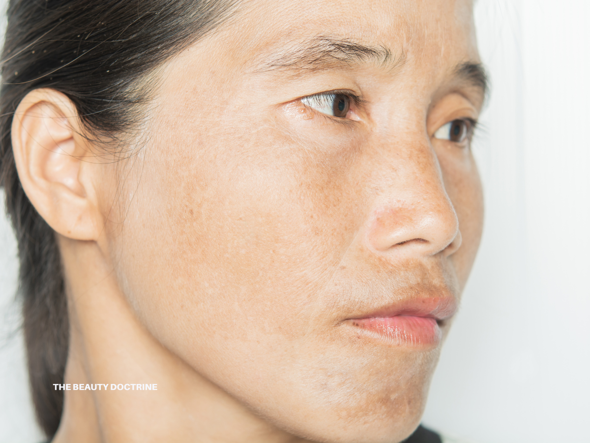 how-to-fade-pigmentation-naturally-without-harsh-treatments