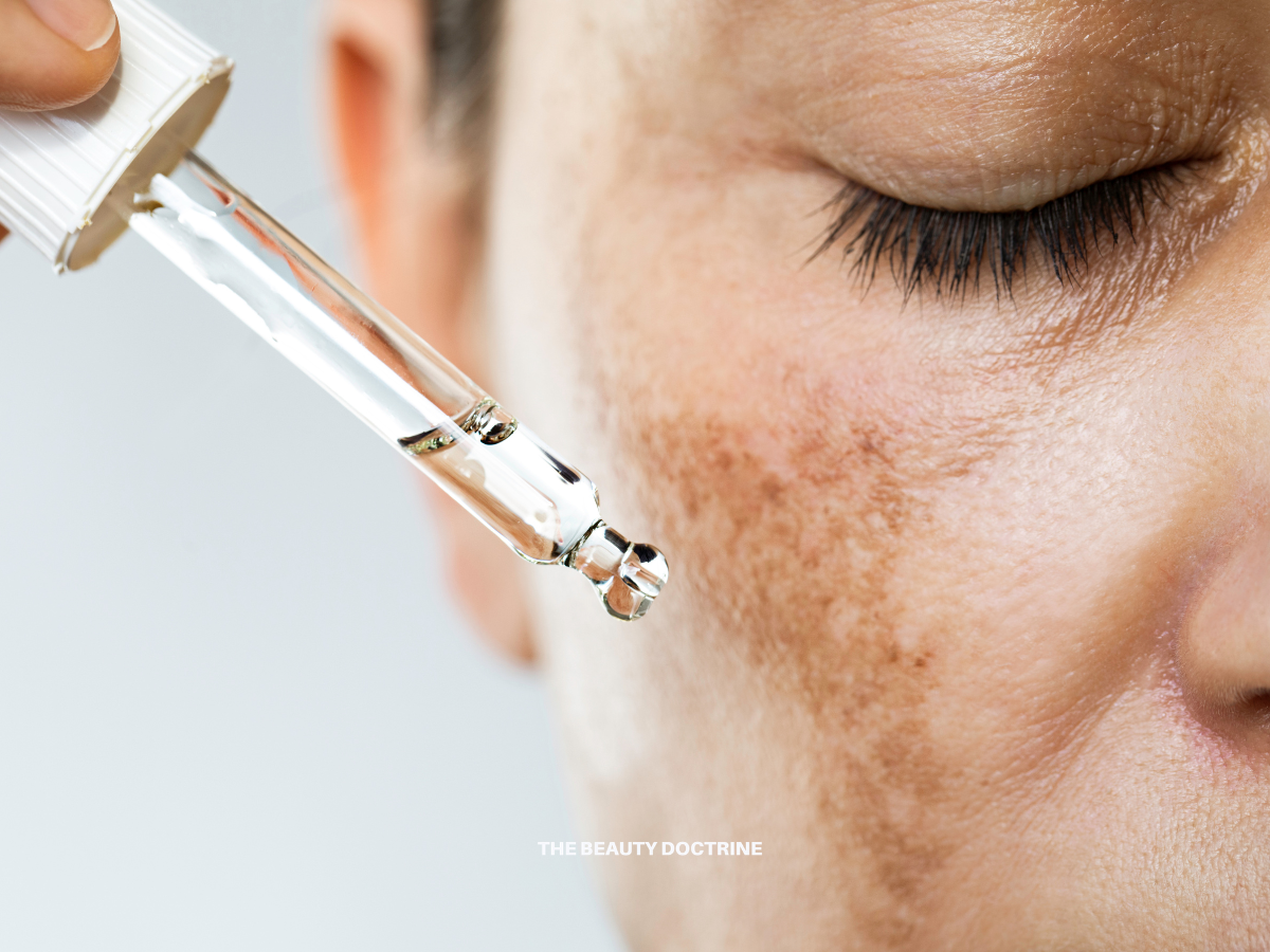 How to Treat Hyperpigmentation Naturally