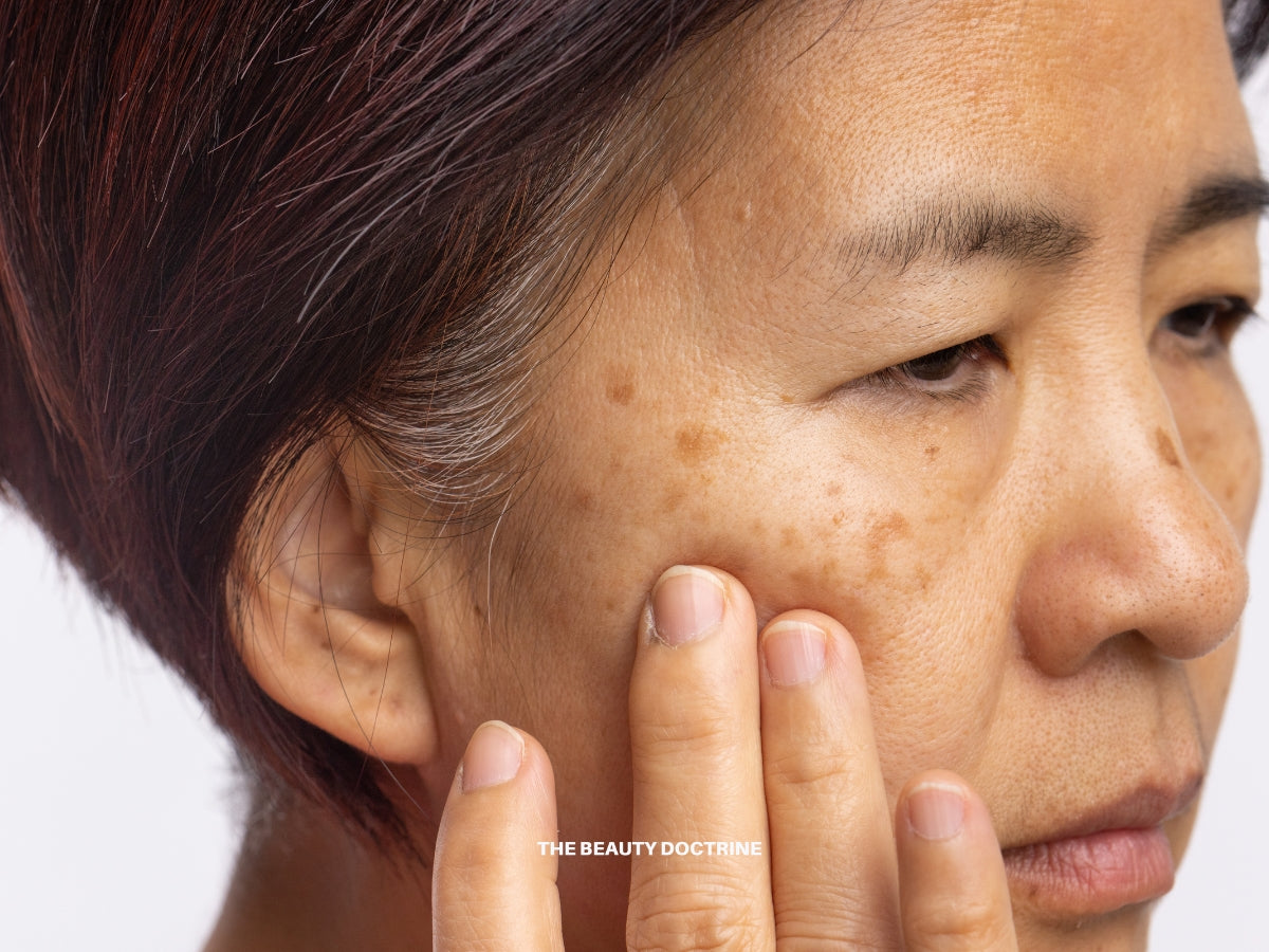 Melasma is not just pigment — understanding the root cause and why mainstream treatments often fail