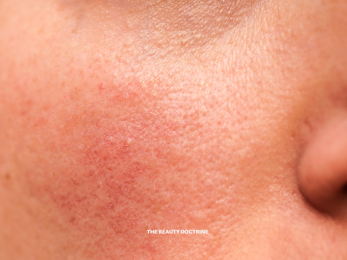 Why Your Skin Is Red: The Complete Guide to Facial Redness, Flushing, and Irritated Skin