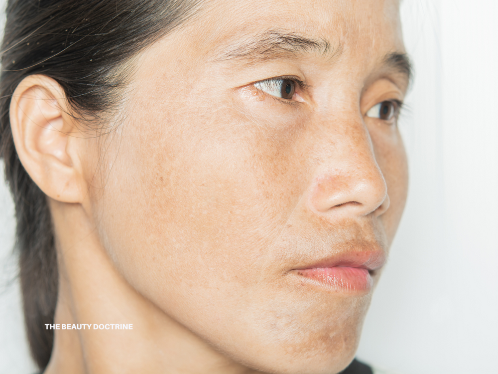 Hyperpigmentation: The Real Causes - The Beauty Doctrine