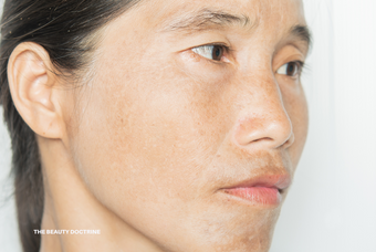 Hyperpigmentation: The Real Causes