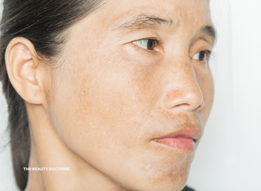 Hyperpigmentation: The Real Causes